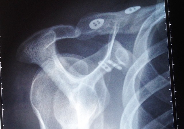 Shoulder Ligament Rupture: Between Self-Pity and Screw It!